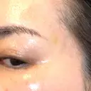 PRP皮膚再生療法 ももスキンケアクリニック DAY 8 サムネイル用