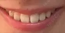 ガミースマイル手術 有楽町美容外科クリニック AFTER サムネイル用
