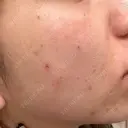 ピコフラクショナルレーザー（毛穴・ニキビ跡） CLINICA BellaForma DAY 0 サムネイル用