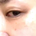 PRP皮膚再生療法 / その他（目元） ももスキンケアクリニック DAY 13 サムネイル用