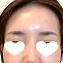 PRP皮膚再生療法 ももスキンケアクリニック AFTER サムネイル用