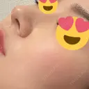 その他（鼻） / 軟骨移植 / 鼻尖形成（非切開） WOM CLINIC GINZA （ワム クリニック ギンザ） DAY 8 サムネイル用
