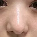 軟骨移植 / 鼻孔縁挙上 / 鼻尖縮小 くさのたろうクリニック AFTER サムネイル用