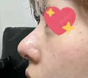 軟骨移植 / 鼻孔縁挙上 / 鼻尖縮小 くさのたろうクリニック DAY 32 サムネイル用