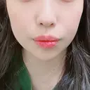 ヒアルロン酸注入（あご） ASTRA BEAUTY CLINIC DAY 0 サムネイル用