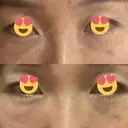 クマ治療 / 下まぶたの脂肪取り / ヒアルロン酸注入（目の下） / ボトックス（眉間） / ボトックス（目尻） / その他（鼻） YBC横浜美容外科 大宮院 DAY 1 サムネイル用