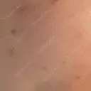 毛穴洗浄（ハイドラフェイシャルなど） / ニードルRF（ポテンツァなど） 表参道メディカルクリニック 横浜院	 DAY 2 サムネイル用