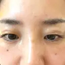 PRP皮膚再生療法 / その他（目元） ももスキンケアクリニック DAY 7 サムネイル用
