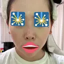 ボトックス（エラ・小顔） LE CLINIC DAY 28 サムネイル用