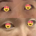 クマ治療 / 下まぶたの脂肪取り / ヒアルロン酸注入（目の下） / ボトックス（眉間） / ボトックス（目尻） / その他（鼻） YBC横浜美容外科 大宮院 DAY 2 サムネイル用