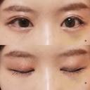 目頭切開 / 目尻切開 / 水光注射（ハリ・美肌） エートップ美容整形外科 DAY 10 サムネイル用