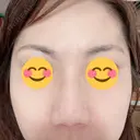 アートメイク（眉） TRUE DESIGN CLINIC DAY 9 サムネイル用