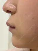 ヒアルロン酸注入（あご） 東京エビスクリニック AFTER サムネイル用