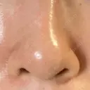 毛穴洗浄（ハイドラフェイシャルなど） / ニードルRF（ポテンツァなど） Zetith Beauty Clinic 銀座院 AFTER サムネイル用