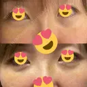 クマ治療 / 下まぶたの脂肪取り / ヒアルロン酸注入（目の下） / ボトックス（眉間） / ボトックス（目尻） / その他（鼻） YBC横浜美容外科 大宮院 DAY 4 サムネイル用