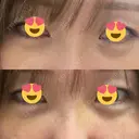 クマ治療 / 下まぶたの脂肪取り / ヒアルロン酸注入（目の下） / ボトックス（眉間） / ボトックス（目尻） / その他（鼻） YBC横浜美容外科 大宮院 DAY 5 サムネイル用