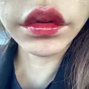 ヒアルロン酸注入（唇） / ボトックス（口角） ルラ美容クリニック 高田馬場院 DAY 8 サムネイル用