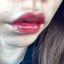 ヒアルロン酸注入（唇） / ボトックス（口角） ルラ美容クリニック 高田馬場院 DAY 8 サムネイル用