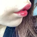 ヒアルロン酸注入（唇） / ボトックス（口角） ルラ美容クリニック 高田馬場院 DAY 8 サムネイル用