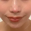 鼻尖形成（切開） / 鼻中隔延長（切開） / 軟骨移植 / 鼻翼基部形成（貴族手術） / 鼻柱下降・鼻唇角形成（猫手術） MAe Clinic 東京院 DAY 94 サムネイル用