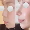 鼻尖形成（切開） / 鼻中隔延長（切開） / 軟骨移植 / 鼻翼基部形成（貴族手術） / 鼻柱下降・鼻唇角形成（猫手術） MAe Clinic 東京院 AFTER サムネイル用