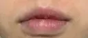 口唇縮小術 B-LINE CLINIC 池袋院 AFTER サムネイル用