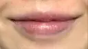 口唇縮小術 B-LINE CLINIC 池袋院 DAY 94 サムネイル用