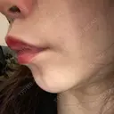 ヒアルロン酸注入（唇） / ボトックス（口角） ルラ美容クリニック 高田馬場院 DAY 9 サムネイル用