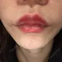 ヒアルロン酸注入（唇） / ボトックス（口角） ルラ美容クリニック 高田馬場院 DAY 9 サムネイル用