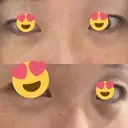 クマ治療 / 下まぶたの脂肪取り / ヒアルロン酸注入（目の下） / ボトックス（眉間） / ボトックス（目尻） / その他（鼻） YBC横浜美容外科 大宮院 DAY 6 サムネイル用