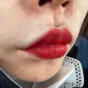 ヒアルロン酸注入（唇） / ボトックス（口角） ルラ美容クリニック 高田馬場院 DAY 10 サムネイル用