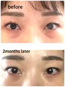 下まぶたの脂肪取り / 脂肪注入（目の下） セオリークリニック DAY 62 サムネイル用