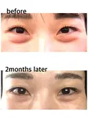 下まぶたの脂肪取り / 脂肪注入（目の下） セオリークリニック DAY 62 サムネイル用