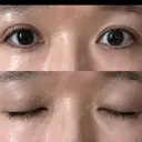 二重埋没 水の森美容クリニック 東京新宿院 DAY 11 サムネイル用