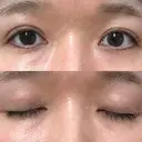二重埋没 水の森美容クリニック 東京新宿院 DAY 12 サムネイル用