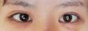 目頭切開 / 目尻切開 / 水光注射（ハリ・美肌） エートップ美容整形外科 DAY 11 サムネイル用
