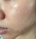 ピコレーザートーニング（美白・肝斑） / ピコフラクショナルレーザー（毛穴・ニキビ跡） ルラ美容クリニック 渋谷本院 DAY 8 サムネイル用