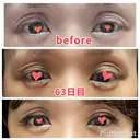 二重切開 / 眼瞼下垂（切開） / 上まぶたたるみ取り 心斎橋形成外科スキンケアクリニック DAY 63 サムネイル用