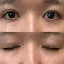 二重埋没 水の森美容クリニック 東京新宿院 DAY 13 サムネイル用