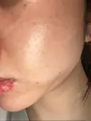 ピコレーザートーニング（美白・肝斑） / ピコフラクショナルレーザー（毛穴・ニキビ跡） ルラ美容クリニック 渋谷本院 DAY 9 サムネイル用