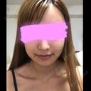 骨削り（エラ） / 骨削り（頬） / その他（輪郭） / 目尻切開 / タレ目形成・グラマラスライン（切開） / 輪郭修正 ウォンジン（Wonjin）整形外科 DAY 17 サムネイル用