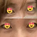 クマ治療 / 下まぶたの脂肪取り / ヒアルロン酸注入（目の下） / ボトックス（眉間） / ボトックス（目尻） / その他（鼻） YBC横浜美容外科 大宮院 DAY 7 サムネイル用