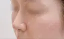 軟骨移植 ソウルクイーン整形外科（旧コエンミ整形外科） DAY 30 サムネイル用
