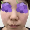 ピーリング（ハリ・ツヤ） まゆりなclinic 名古屋栄 DAY 0 サムネイル用