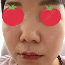 ピーリング（ハリ・ツヤ） まゆりなclinic 名古屋栄 DAY 1 サムネイル用