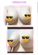 豊胸（脂肪注入） / その他（胸） クリニックビューティー恵比寿 DAY 646 サムネイル用