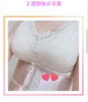 豊胸（脂肪注入） / その他（胸） クリニックビューティー恵比寿 DAY 646 サムネイル用