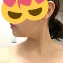 ボトックス（エラ・小顔） / ボトックス（肩） メディカルアルファクリニック DAY 7 サムネイル用