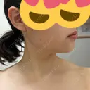 ボトックス（エラ・小顔） / ボトックス（肩） メディカルアルファクリニック DAY 7 サムネイル用
