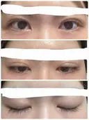 二重埋没 湘南美容クリニック 仙台院 DAY 27 サムネイル用